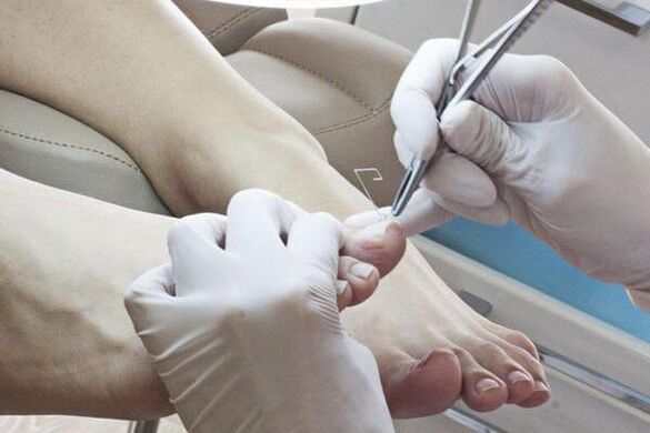 nail fungus treatment by a doctor