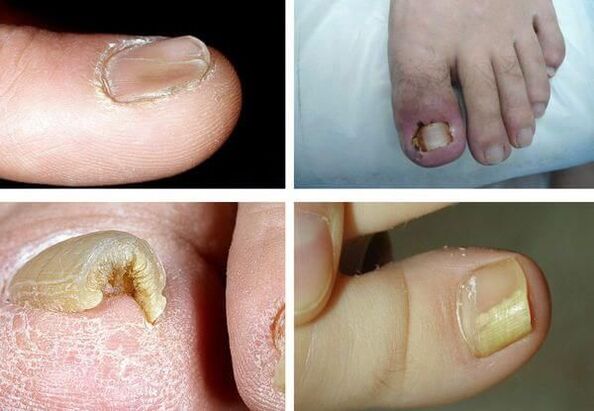 what does fungus on nails look like