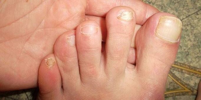 Why nail fungus is dangerous