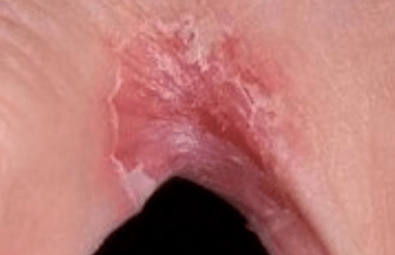 Mushroom on the legs between the fingers