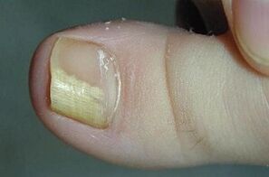 The reasons for the appearance of the mushroom on the thumb of the leg