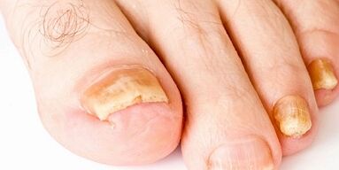 How and how to treat the nail fungus