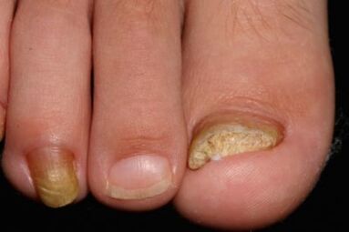 Mycosis of nails on the legs