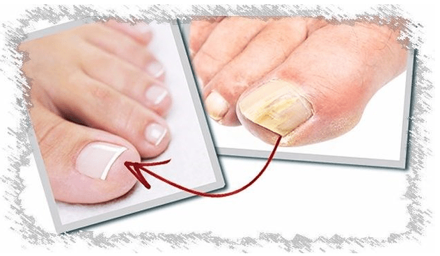 Causes of nail mushrooms