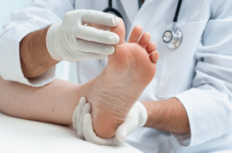 Treatment of the nail fungus