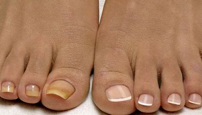 The causes of the apparition of the mushroom on the nails