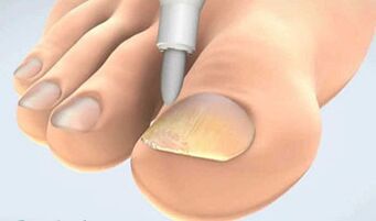 collection scraping onychomycosis