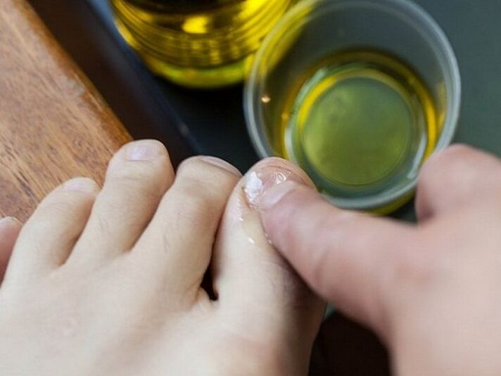 Application of medicated oil on nails affected by fungus