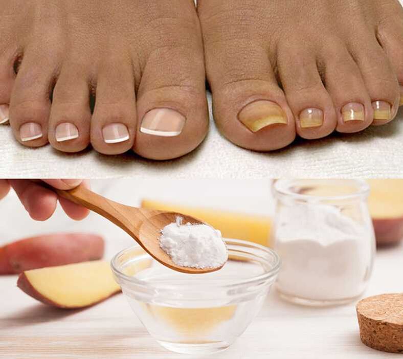 Soda for the treatment of nail fungus