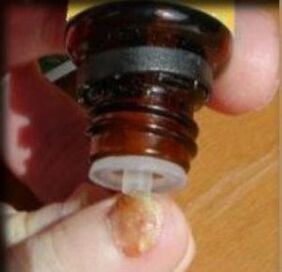 Application of drops on a nail affected by fungus